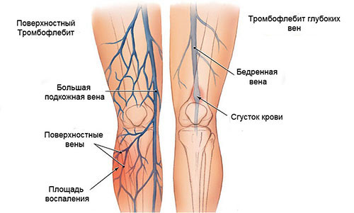 Какие бывают болезни вен